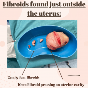 Fibroids in pregnancy