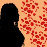 Woman with sickle cells